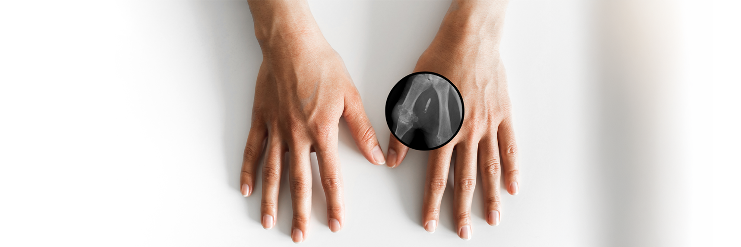 Hand with implantation of micro chip. X-Ray view close-up.